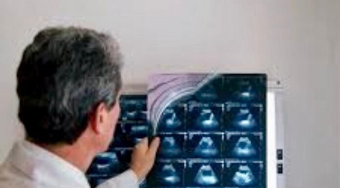 FOMENTAN DETECCIONES OPORTUNAS DE CÁNCER VESICAL